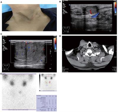 Multidisciplinary Diagnosis of Subcutaneous Soft Tissue Metastasis of Follicular Thyroid Carcinoma: A Case Report